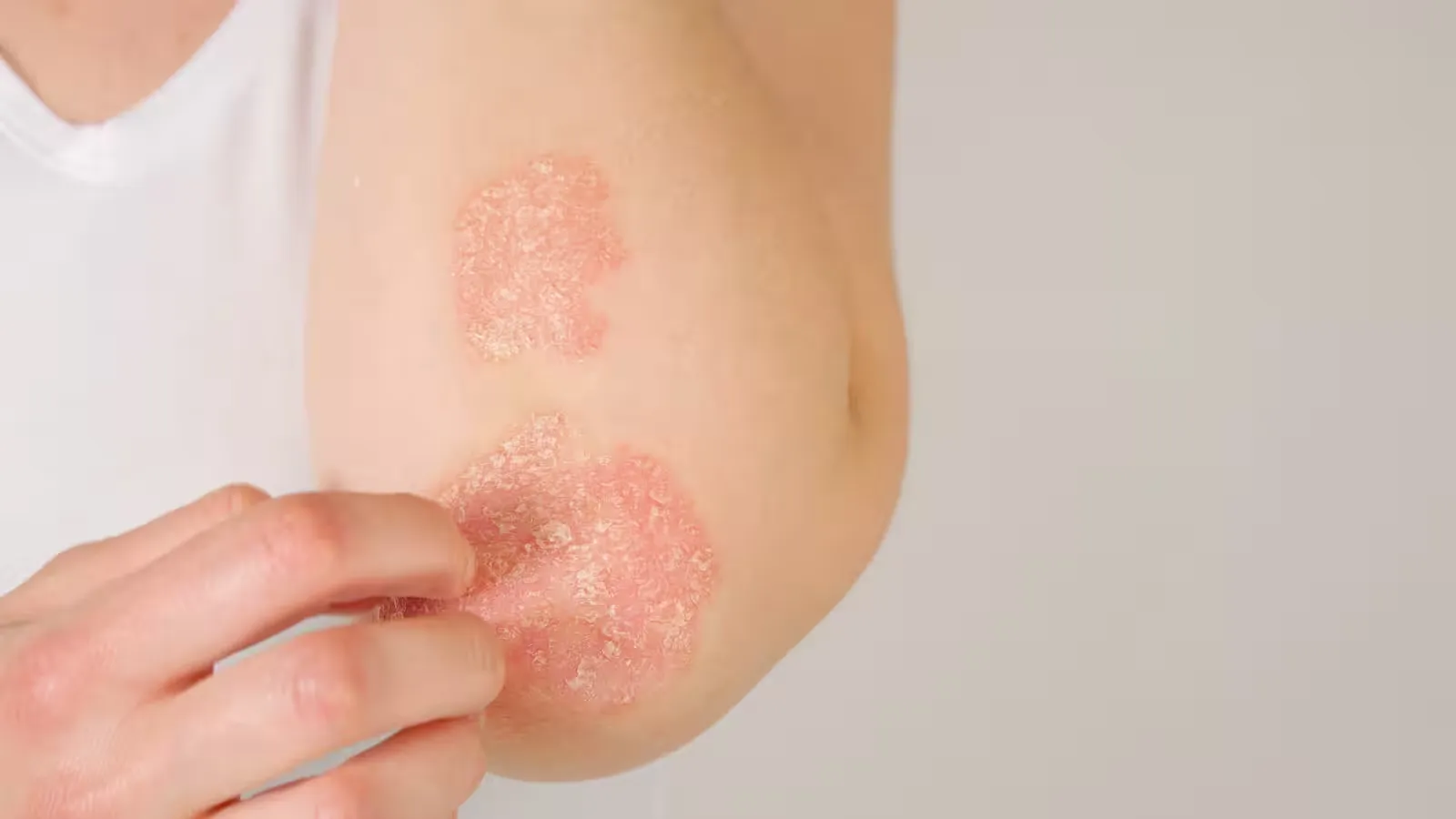 Psoriasis patches on a person's elbow.